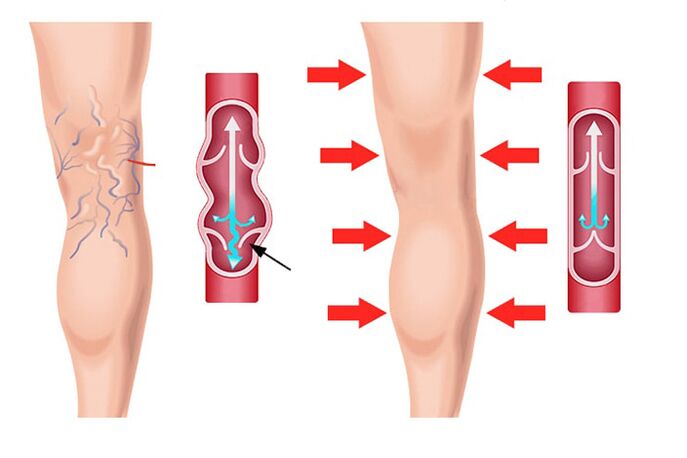 Effetto del gel Levicose nel trattamento