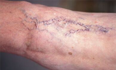 Metodi per il trattamento delle vene varicose sulle gambe