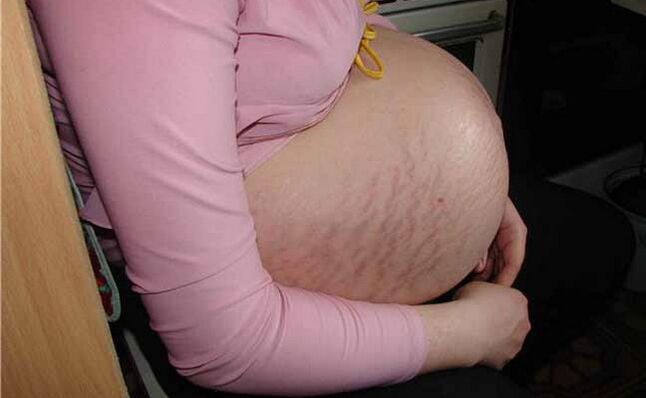 Cause delle vene varicose durante la gravidanza