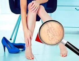 I sintomi dipendono dal tipo e dallo stadio delle vene varicose