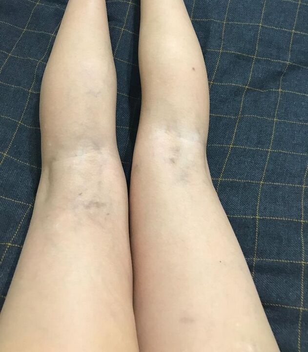 Manifestazioni di vene varicose sulle gambe