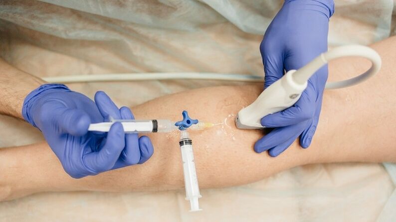 Scleroterapia per vene varicose