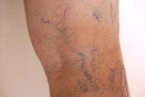 Vene varicose sulle gambe