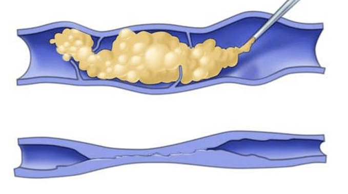 Scleroterapia per vene varicose